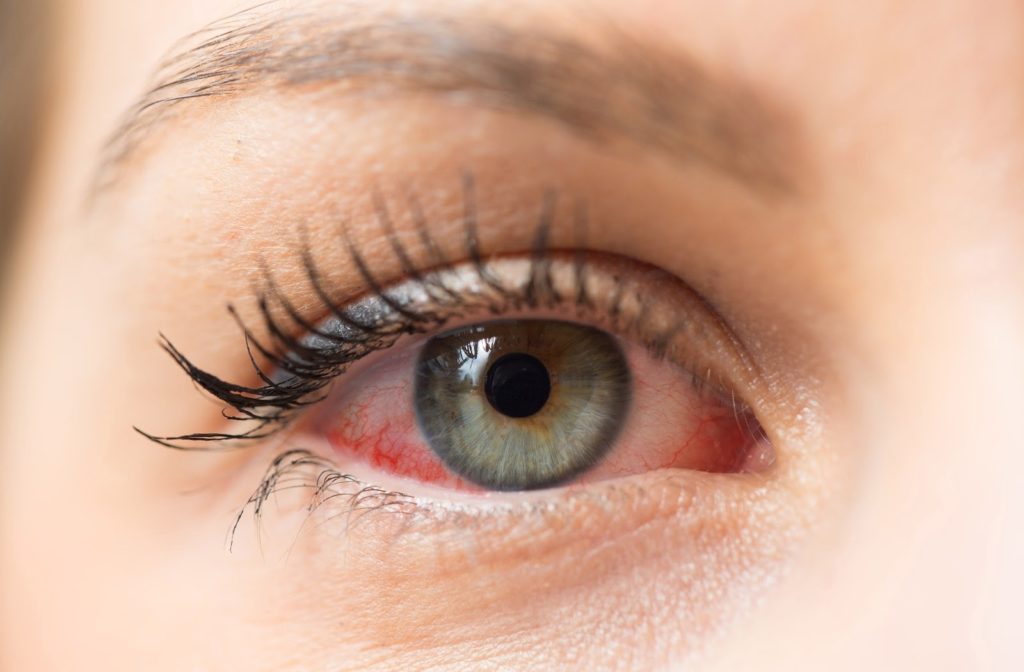 A woman with a watery and red eye caused by dry eye