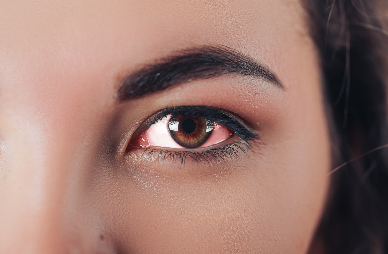 A young woman with a red irritated eye