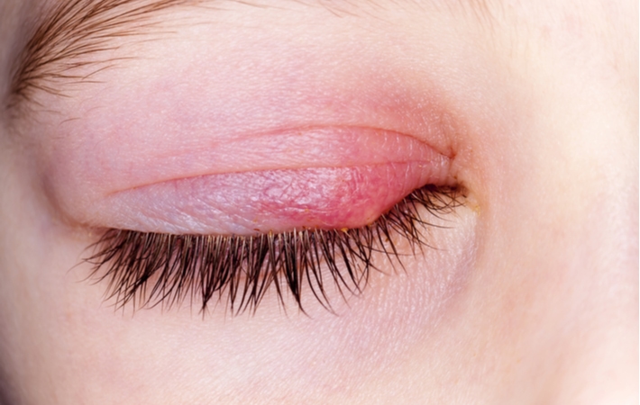 A close-up view of a woman's closed eye, with a red, swollen eyelid caused by a stye