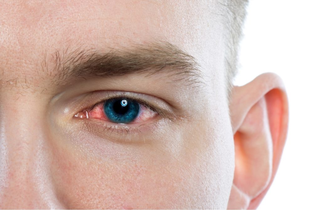 A close up of a man's left eye, suffering from pink eye
