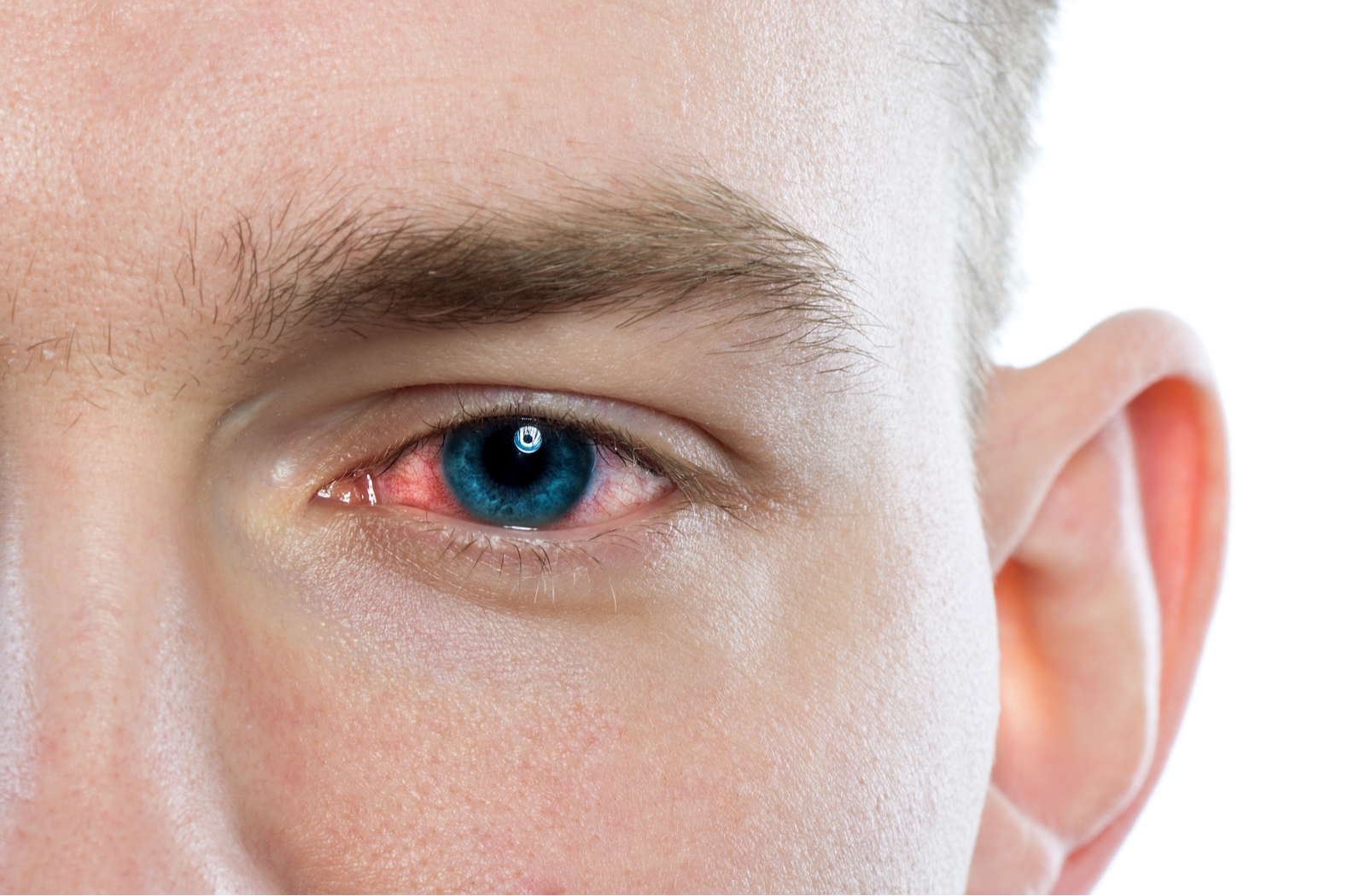 Сужает зрачки общий эффект воздействия. Красные глаза наркомана.