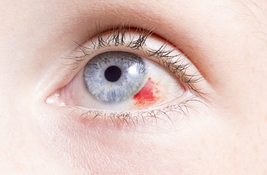 A close up of a person's eye with broken blood vessels on the right side