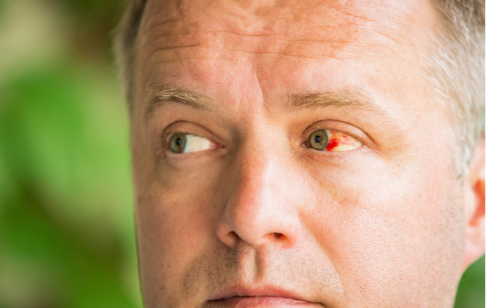 A man looking to the right, allowing broken blood vessels in his left eye to be visible as he suffers from Subconjunctival Hemorrhages
